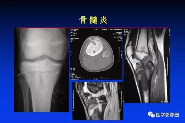 【PPT】骨肿瘤影像分析方法和诊断思路