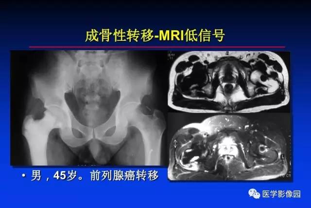 【PPT】骨肿瘤影像分析方法和诊断思路
