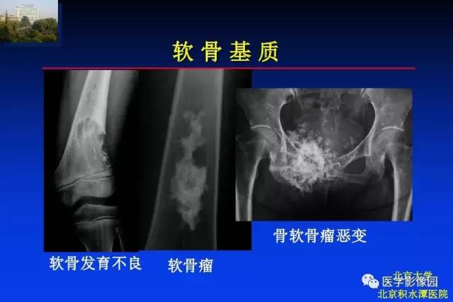 【PPT】骨肿瘤影像分析方法和诊断思路