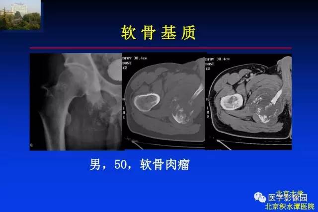 【PPT】骨肿瘤影像分析方法和诊断思路