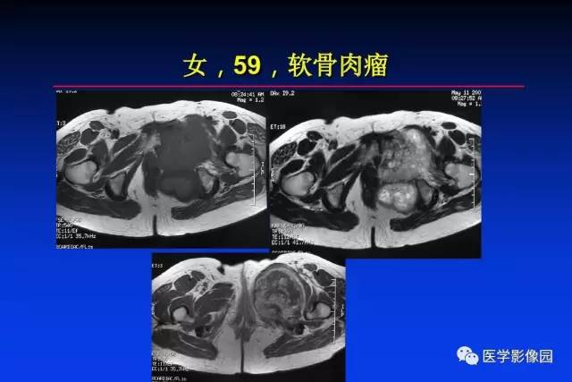【PPT】骨肿瘤影像分析方法和诊断思路
