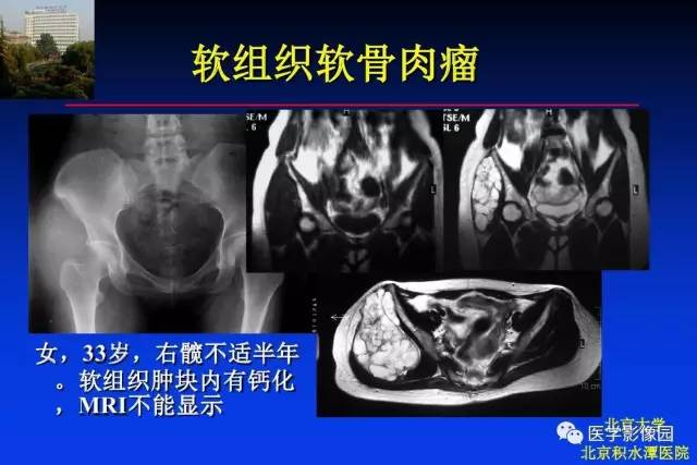【PPT】骨肿瘤影像分析方法和诊断思路