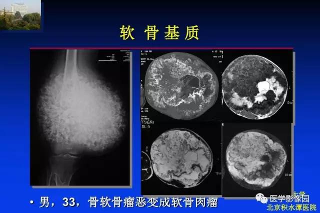 【PPT】骨肿瘤影像分析方法和诊断思路