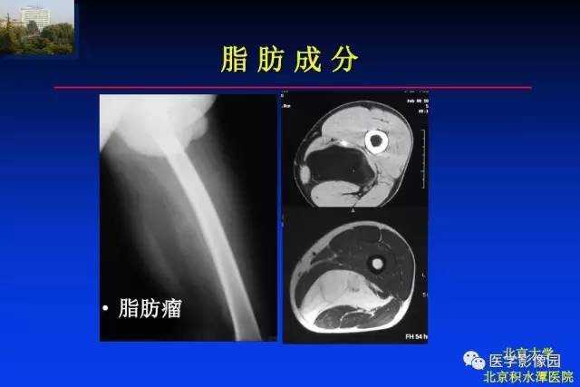【PPT】骨肿瘤影像分析方法和诊断思路
