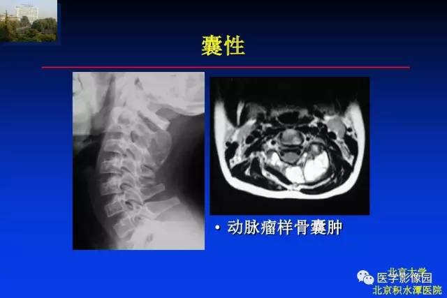 【PPT】骨肿瘤影像分析方法和诊断思路