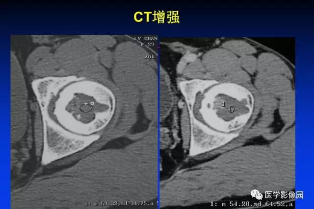 【PPT】骨肿瘤影像分析方法和诊断思路
