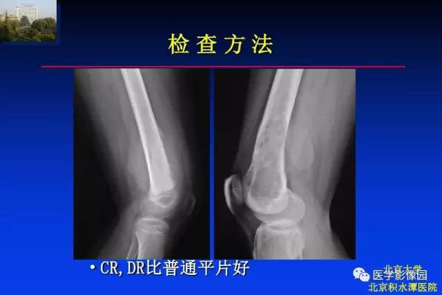 【PPT】骨肿瘤影像分析方法和诊断思路