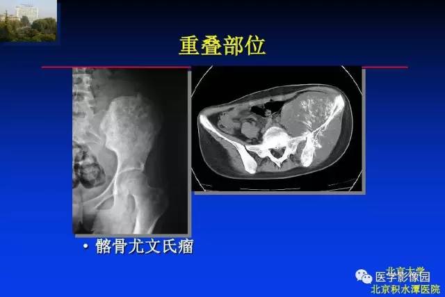 【PPT】骨肿瘤影像分析方法和诊断思路