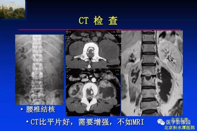 【PPT】骨肿瘤影像分析方法和诊断思路
