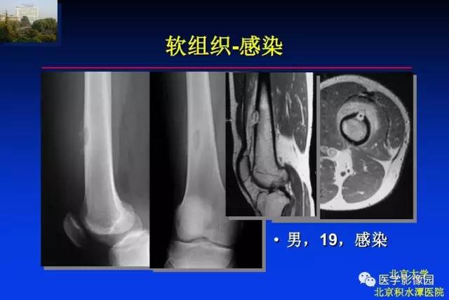 【PPT】骨肿瘤影像分析方法和诊断思路