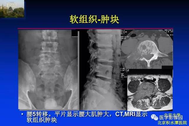 【PPT】骨肿瘤影像分析方法和诊断思路