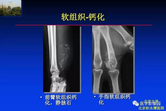 【PPT】骨肿瘤影像分析方法和诊断思路