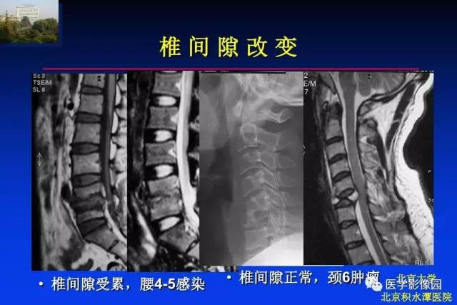 【PPT】骨肿瘤影像分析方法和诊断思路