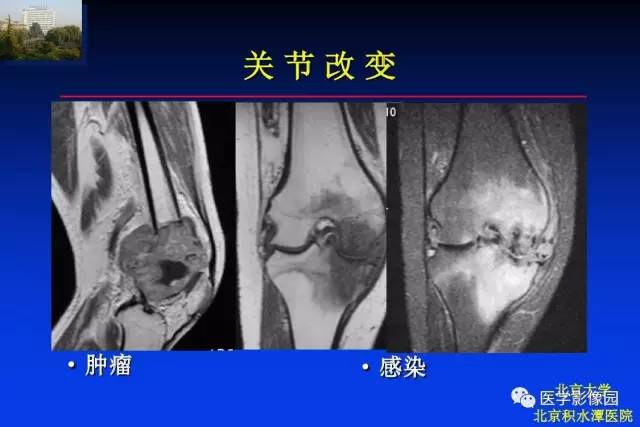 【PPT】骨肿瘤影像分析方法和诊断思路