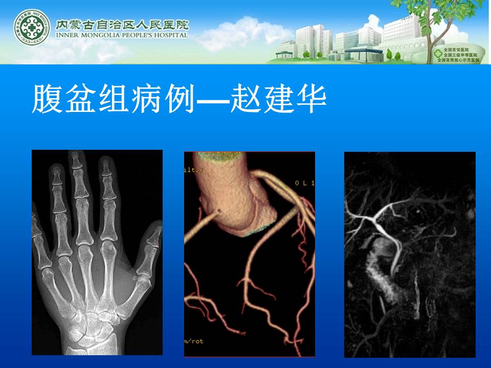 【病例】右侧胸腔孤立性纤维瘤1例CT