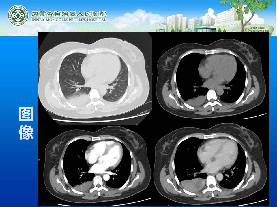 【病例】右侧胸腔孤立性纤维瘤1例CT