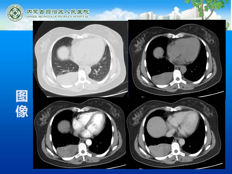 【病例】右侧胸腔孤立性纤维瘤1例CT