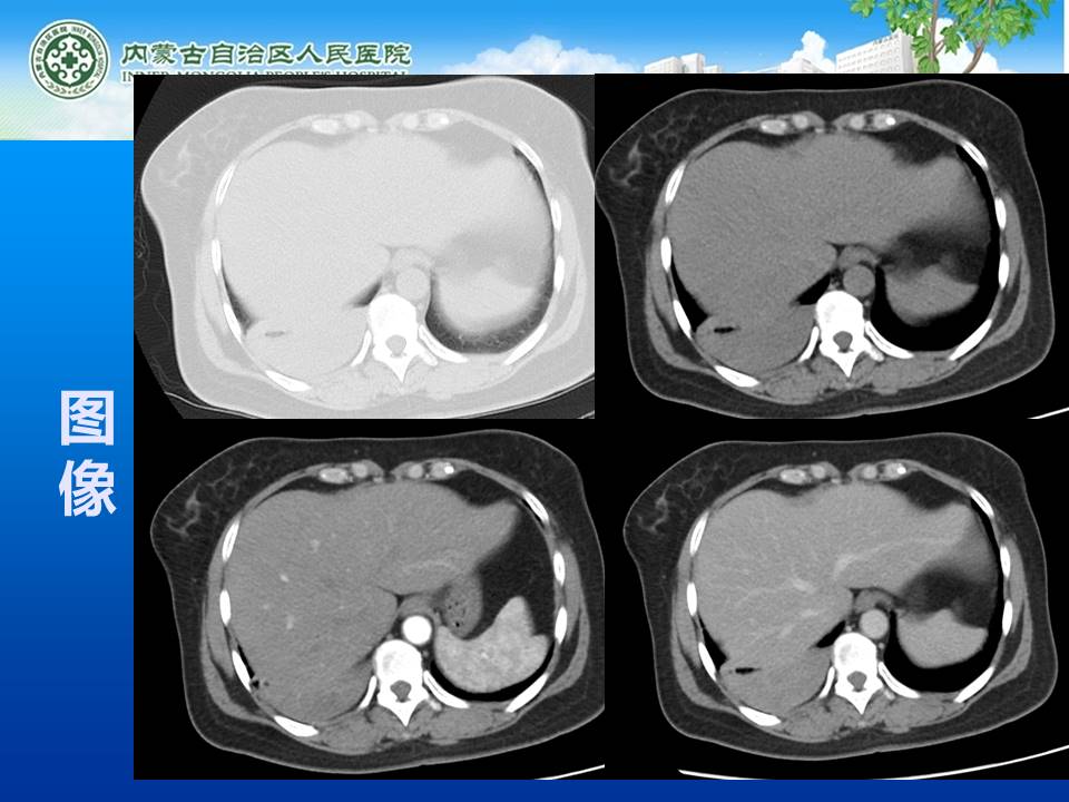【病例】右侧胸腔孤立性纤维瘤1例CT