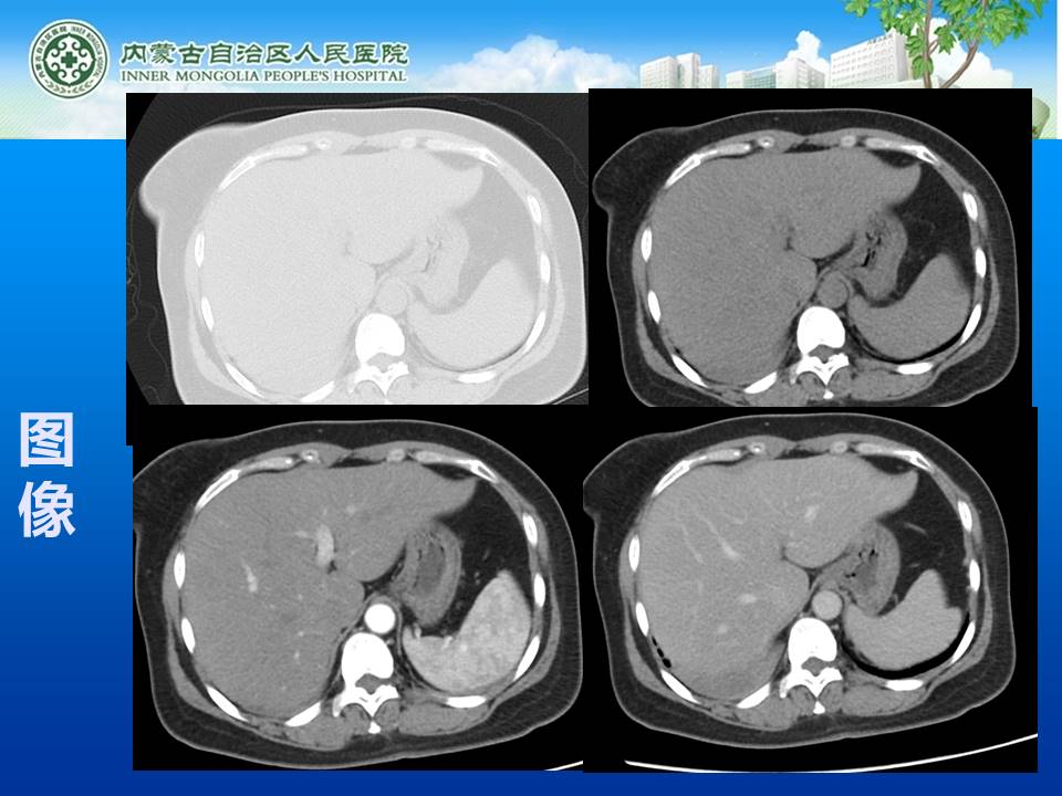 【病例】右侧胸腔孤立性纤维瘤1例CT