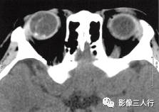 【病例】永存原始玻璃体增生症1例CT影像表现分析