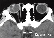 【病例】永存原始玻璃体增生症1例CT影像表现分析