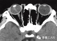 【病例】永存原始玻璃体增生症1例CT影像表现分析