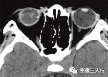 【病例】永存原始玻璃体增生症1例CT影像表现分析