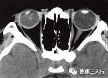 【病例】永存原始玻璃体增生症1例CT影像表现分析