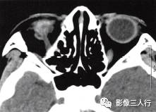 【病例】永存原始玻璃体增生症1例CT影像表现分析