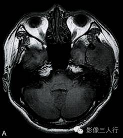 【病例】颅骨软骨母细胞瘤1例CT及MR影像分析