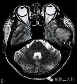【病例】颅骨软骨母细胞瘤1例CT及MR影像分析