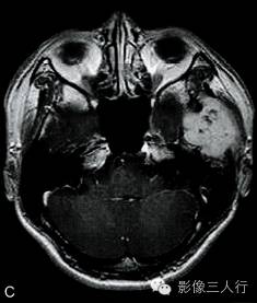 【病例】颅骨软骨母细胞瘤1例CT及MR影像分析