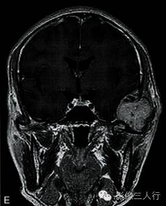 【病例】颅骨软骨母细胞瘤1例CT及MR影像分析