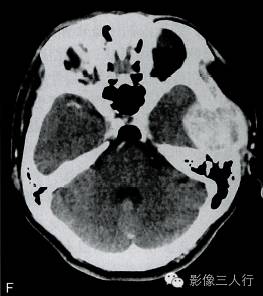 【病例】颅骨软骨母细胞瘤1例CT及MR影像分析