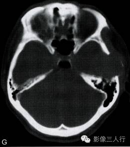 【病例】颅骨软骨母细胞瘤1例CT及MR影像分析