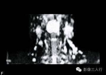 【病例】舌根淋巴瘤1例MR影像表现 【病例】舌根淋巴瘤1例MR影像表现