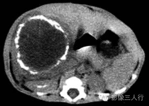 【病例】婴儿型肝血管内皮细胞瘤1例CT影像表现
