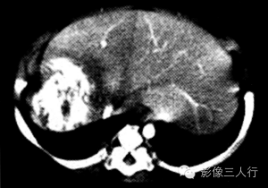 【病例】婴儿型肝血管内皮细胞瘤1例CT影像表现 【病例】婴儿型肝血管内皮细胞瘤1例CT影像表现