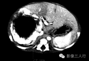 【病例】婴儿型肝血管内皮细胞瘤1例CT影像表现 【病例】婴儿型肝血管内皮细胞瘤1例CT影像表现
