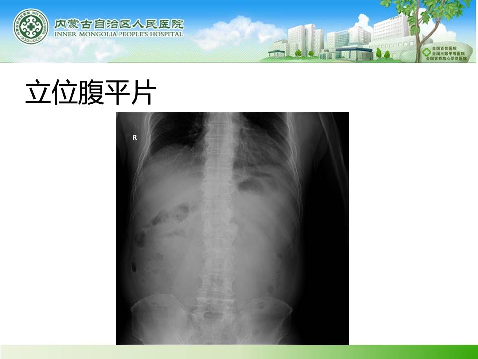 【病例】肠系膜上静脉血栓形成伴小肠梗死1例