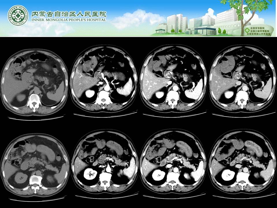 【病例】肠系膜上静脉血栓形成伴小肠梗死1例