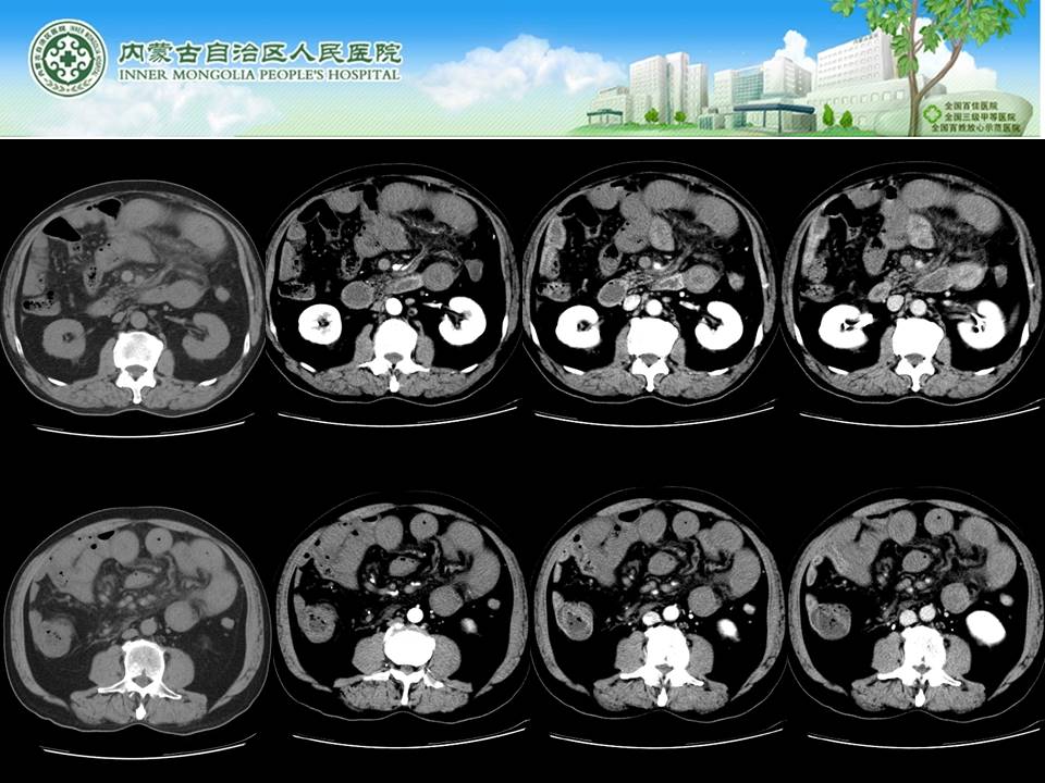 【病例】肠系膜上静脉血栓形成伴小肠梗死1例