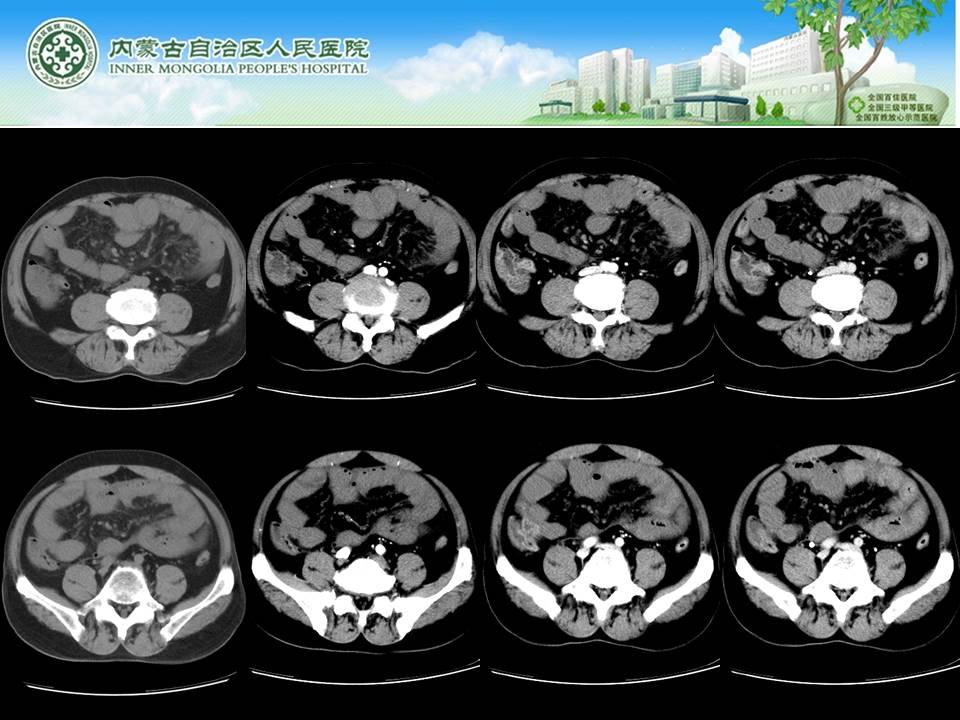 【病例】肠系膜上静脉血栓形成伴小肠梗死1例