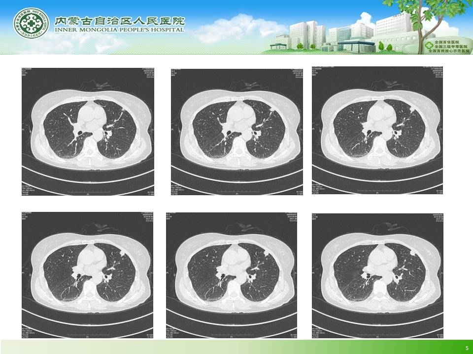 【病例】左肺上叶结核球1例CT
