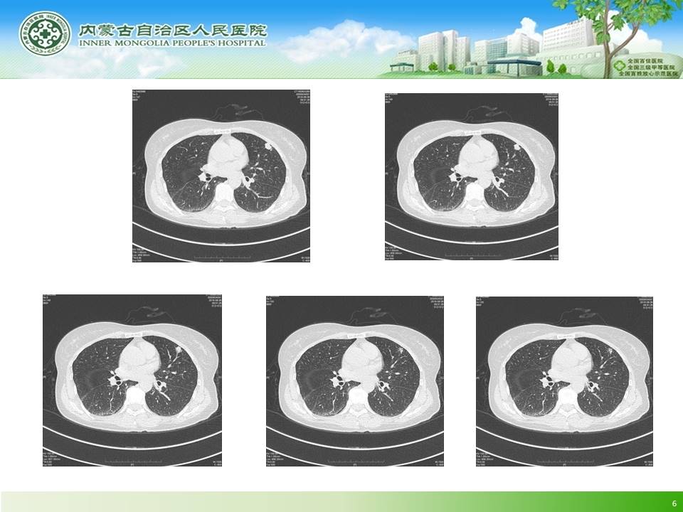 【病例】左肺上叶结核球1例CT