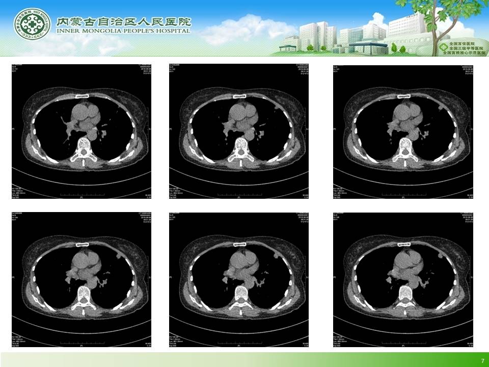 【病例】左肺上叶结核球1例CT