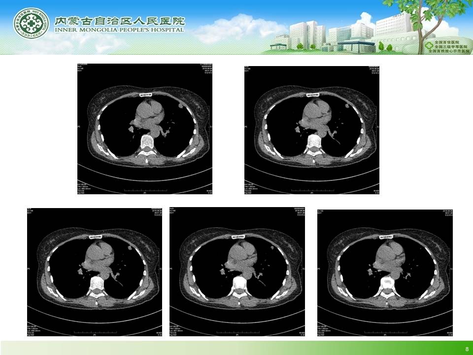 【病例】左肺上叶结核球1例CT
