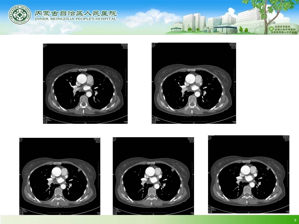 【病例】左肺上叶结核球1例CT