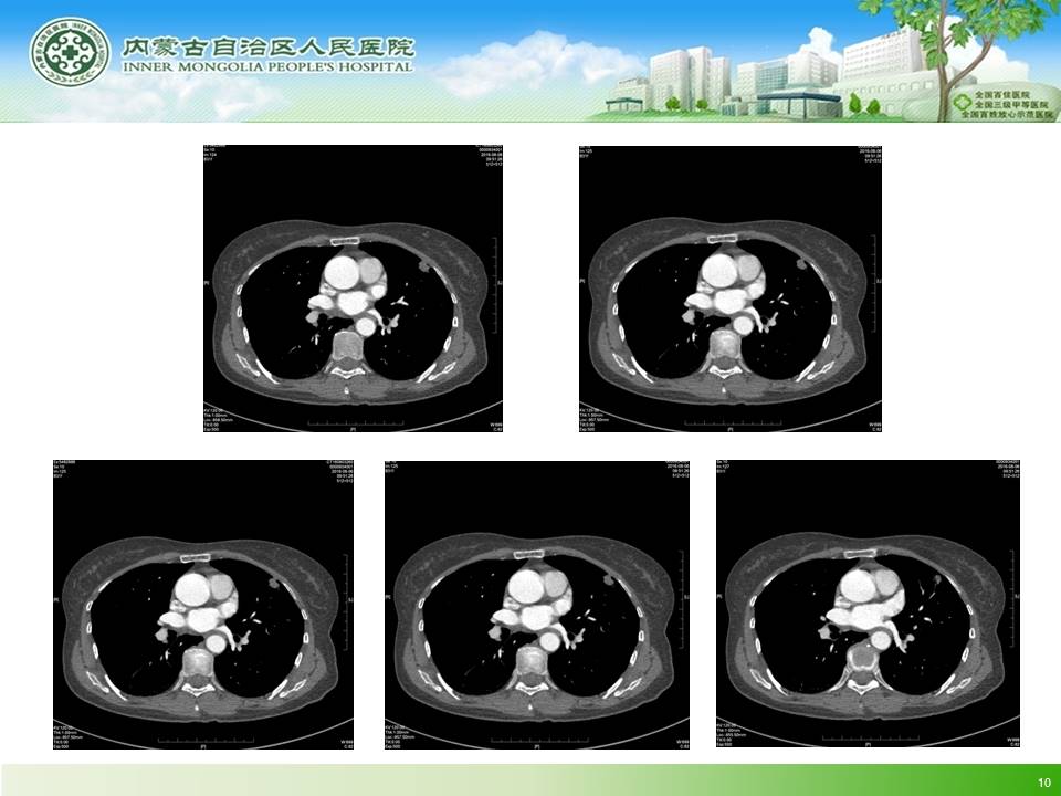 【病例】左肺上叶结核球1例CT
