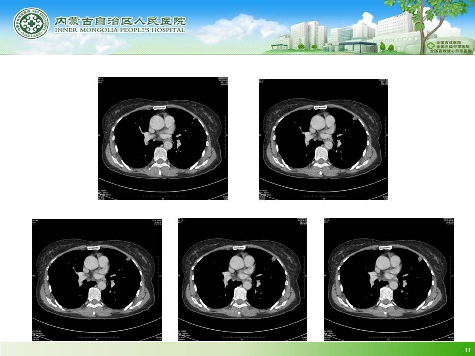 【病例】左肺上叶结核球1例CT